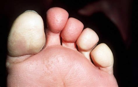 white feet|Raynauds disease: Treatment, causes,。